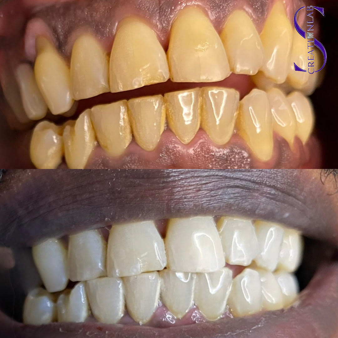 Advanced Teeth Whitening Gel