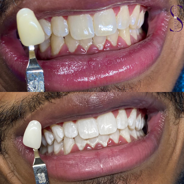 Premium teeth whitening
