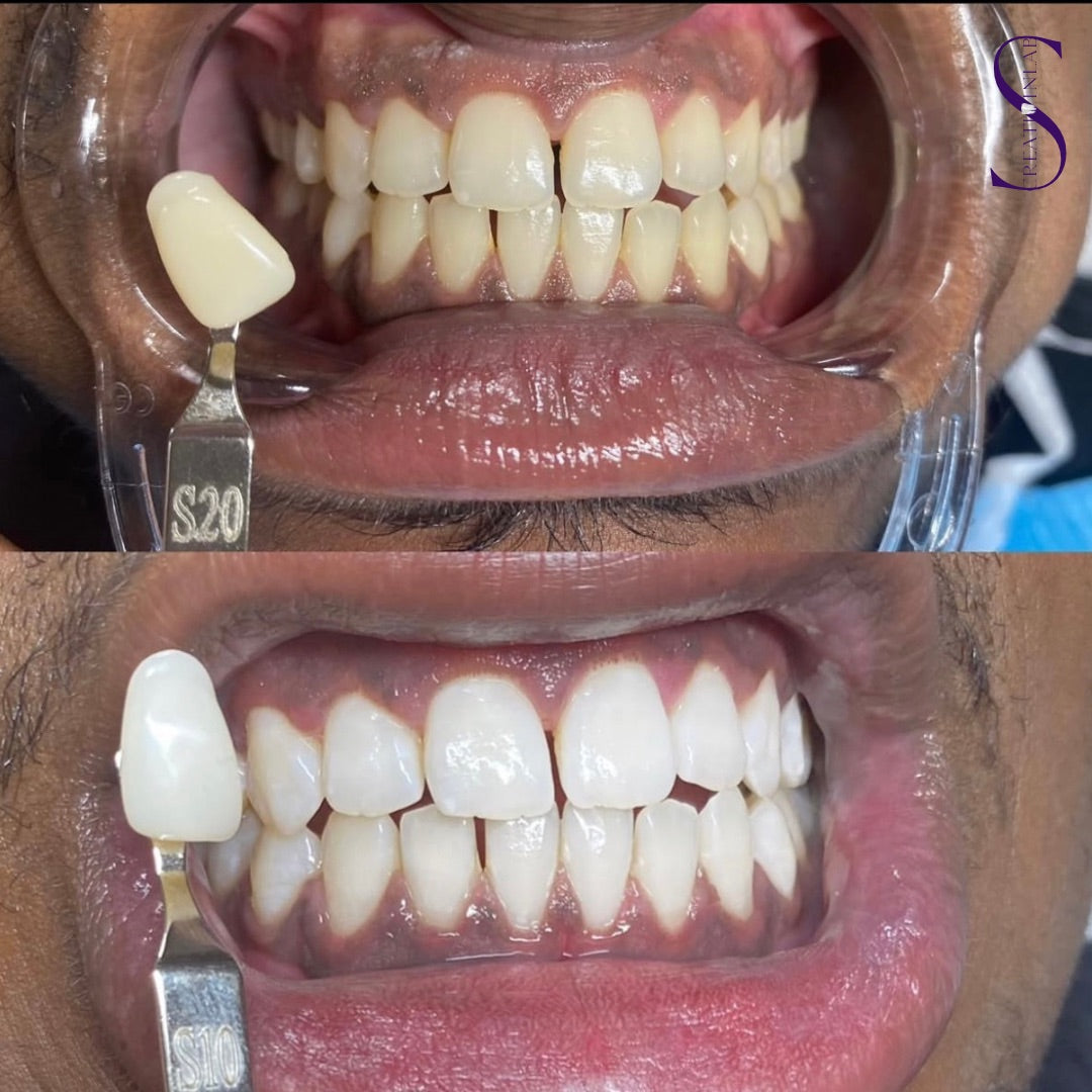 Premium Teeth Whitening Gel