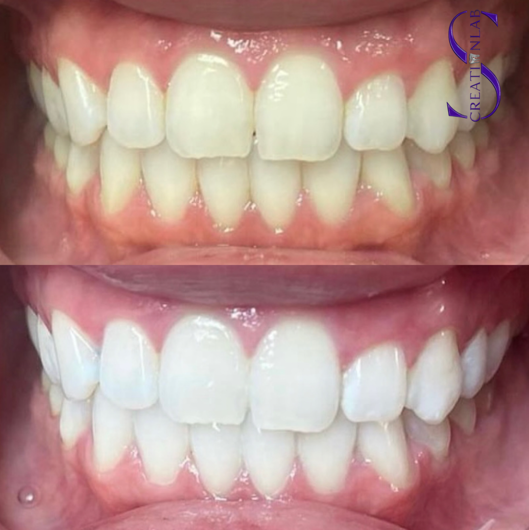 Teeth Brightening Gel (16%)