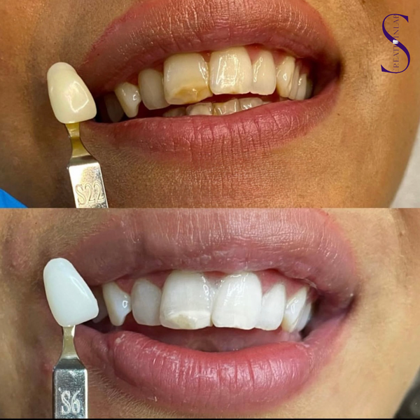 Advanced teeth whitening