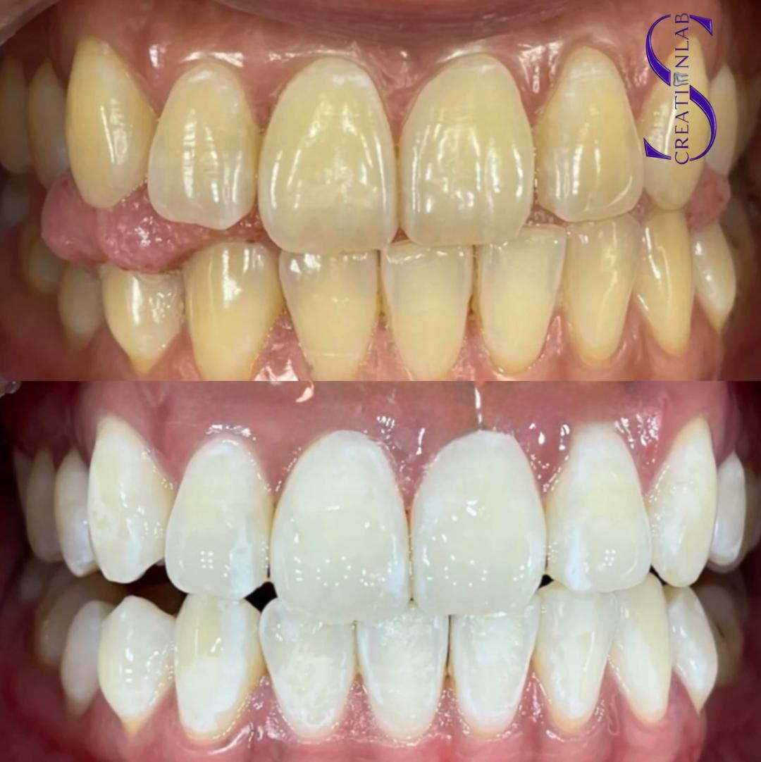 Professional Teeth Whitening Machine (60w)