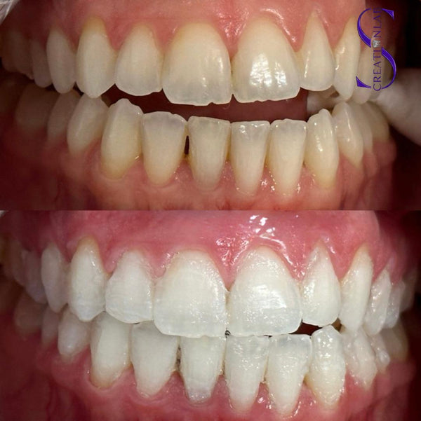 Premium teeth whitening 